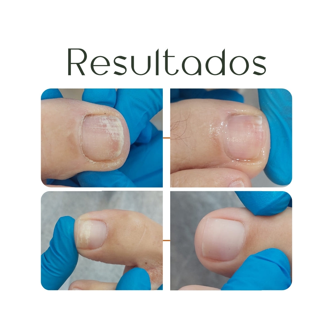 Sérum Ozonizado para Unhas