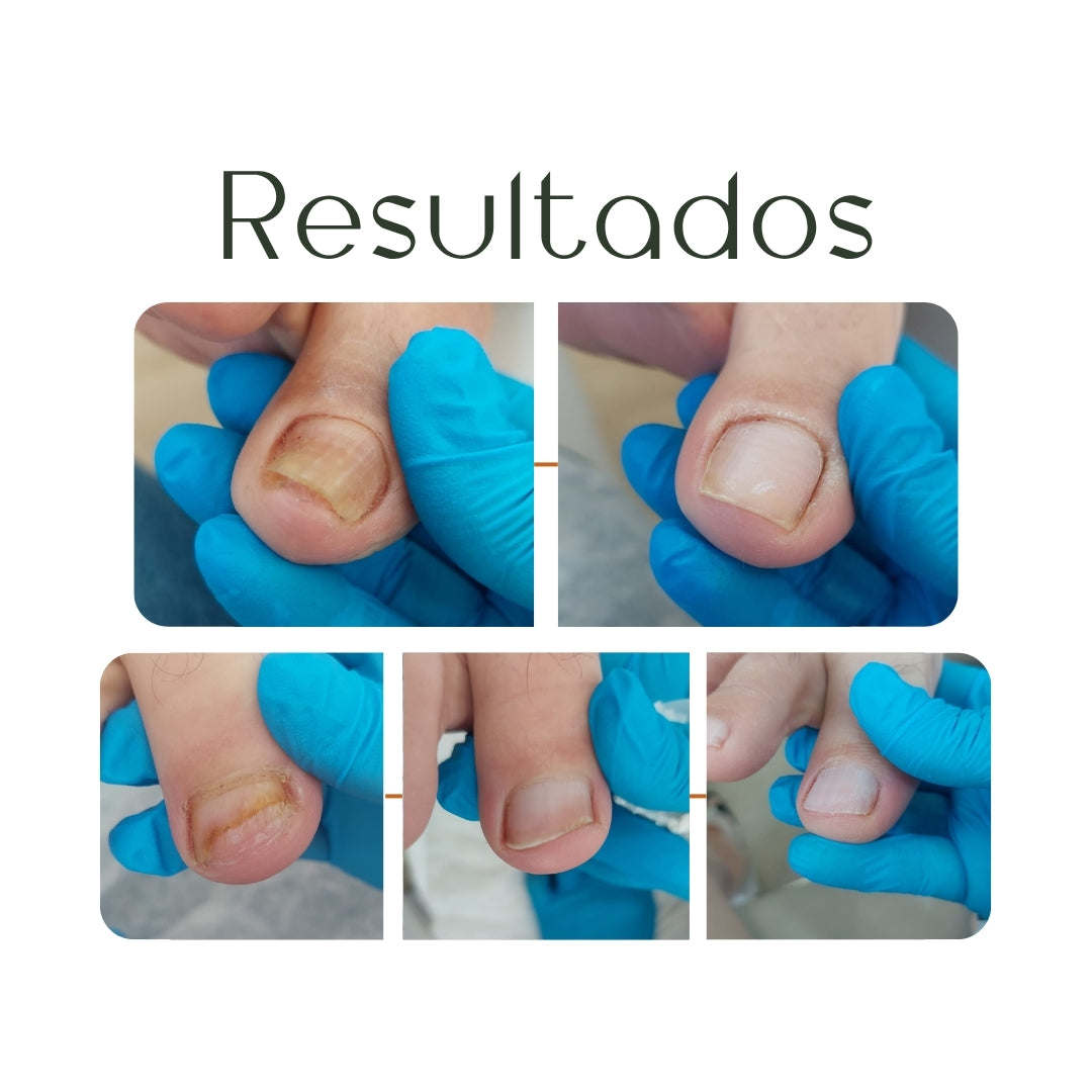 Sérum Ozonizado para Unhas